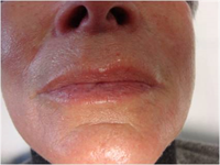 Résultat après injections dermiques d’acides hyaluroniques