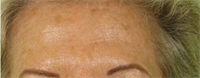 Après injections de toxine botulinique