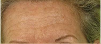 Avant injections de toxine botulinique