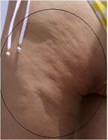 Cellulite