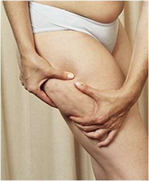 Cellulite