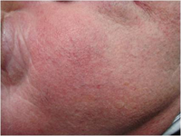 Après traitement de l'erythrocouperose par laser vasculaire