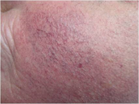 Avant traitement de l'erythrocouperose par laser vasculaire