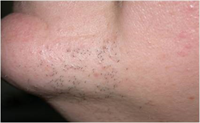 Avant épilation laser