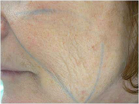 Avant traitement par laser fractionné