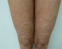 Cellulite sur jambes