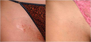 Epilation laser du maillot
